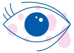 allergia