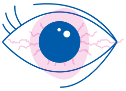 come alleviare con il collirio Iridina i sintomi degli occhi rossi