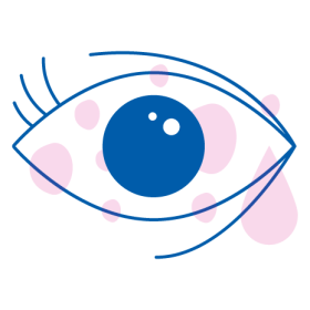 iridina spiega i sintomi dell'allergia agli occhi