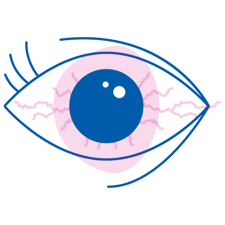 iridina sintomi occhi rossi e irritati