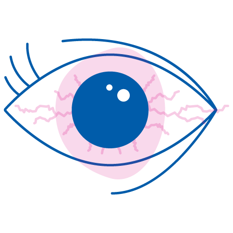 come alleviare con il collirio Iridina i sintomi degli occhi rossi