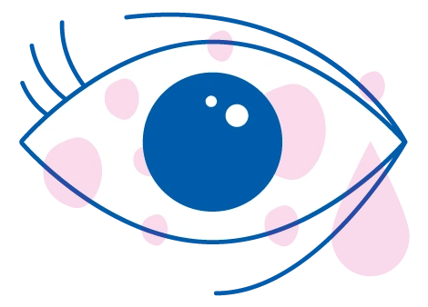 Occhi che pizzicano e lacrimano