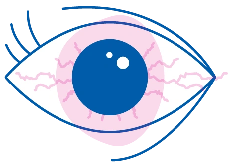 Occhi rossi e irritati